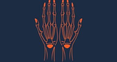 Hands With Rheumatoid Arthritis