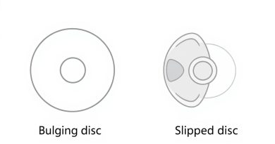 Bulging Disc Vs Slipped Disc