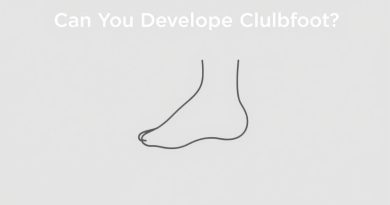 Can You Develop Clubfoot