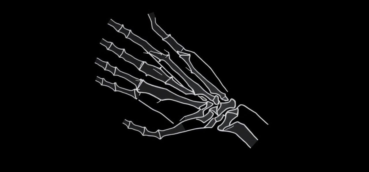 Fracture Of Ulnar Styloid Process