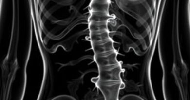 Ligamentum Flavum Hypertrophy Mri