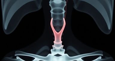 Periungual Fibroma Tuberous Sclerosis