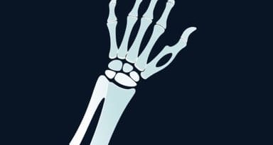 Surgery For Distal Radius Fracture