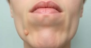 Vertigo Clammy Skin Nausea