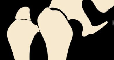 Zimmer Oss Distal Femur