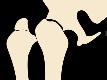 Zimmer Oss Distal Femur