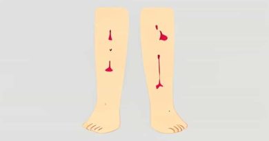 Why Do I Bruise So Easily Legs