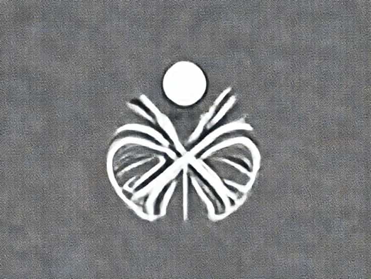 Chronic Inflammatory Demyelinating Polyneuropathy