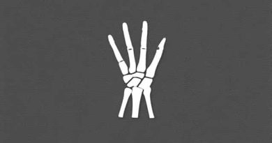 Closed Displaced Fracture Of Proximal Phalanx