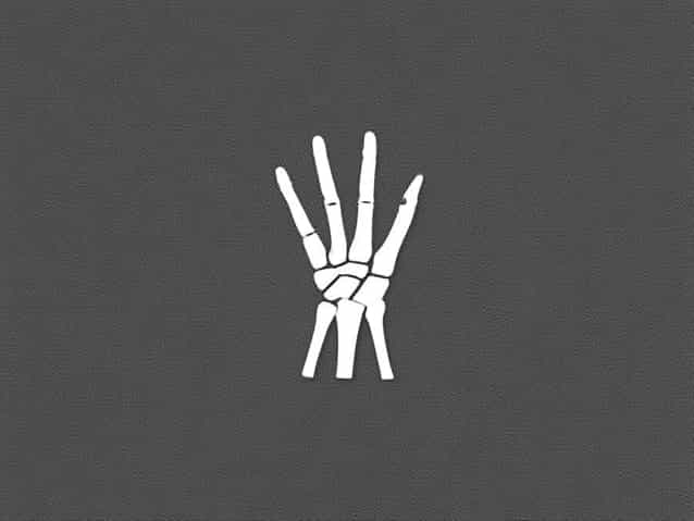 Closed Displaced Fracture Of Proximal Phalanx