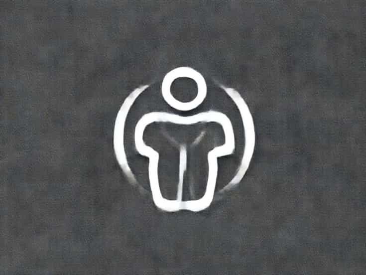 Coolsculpting Paradoxical Adipose Hyperplasia