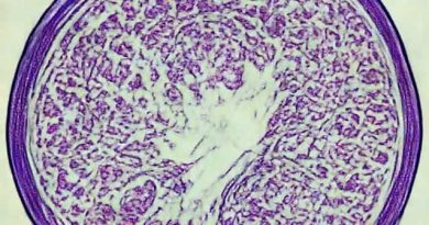 Low Grade Serous Carcinoma Pathology Outlines