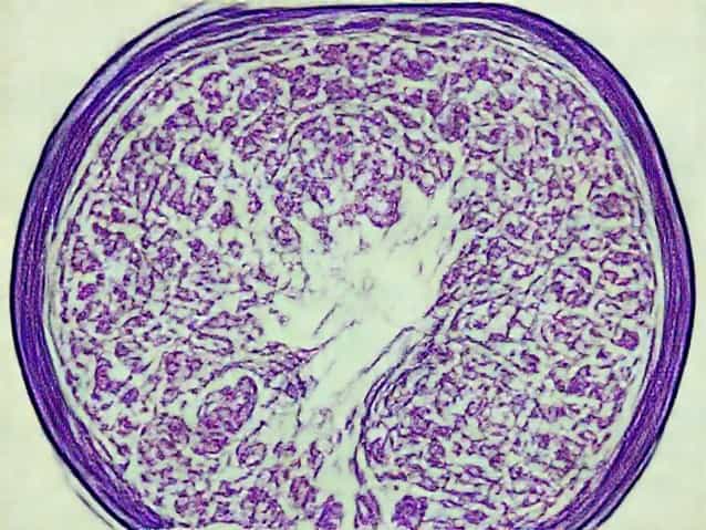 Low Grade Serous Carcinoma Pathology Outlines