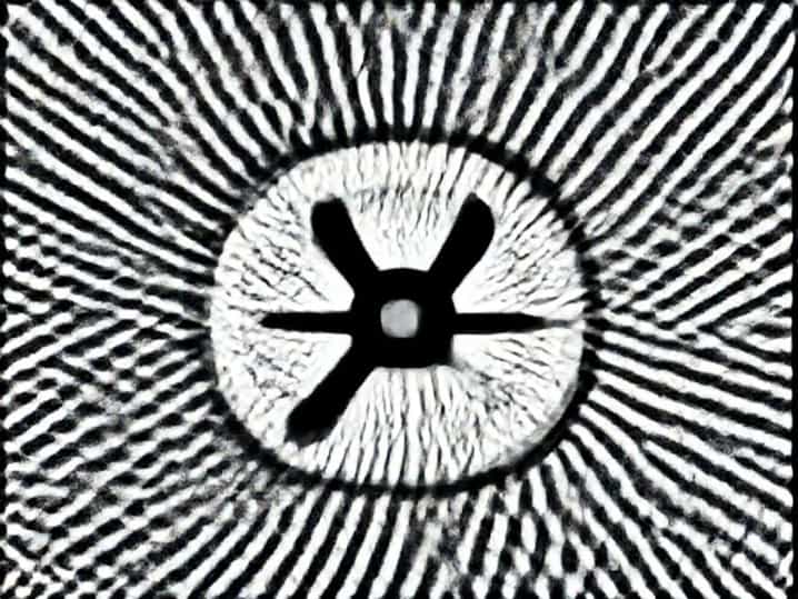 Unharmonious Anomalous Retinal Correspondence