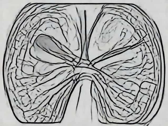 Xanthogranulomatous Cystitis Pathology Outlines