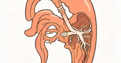 Tracheoesophageal Fistula Embryological Basis